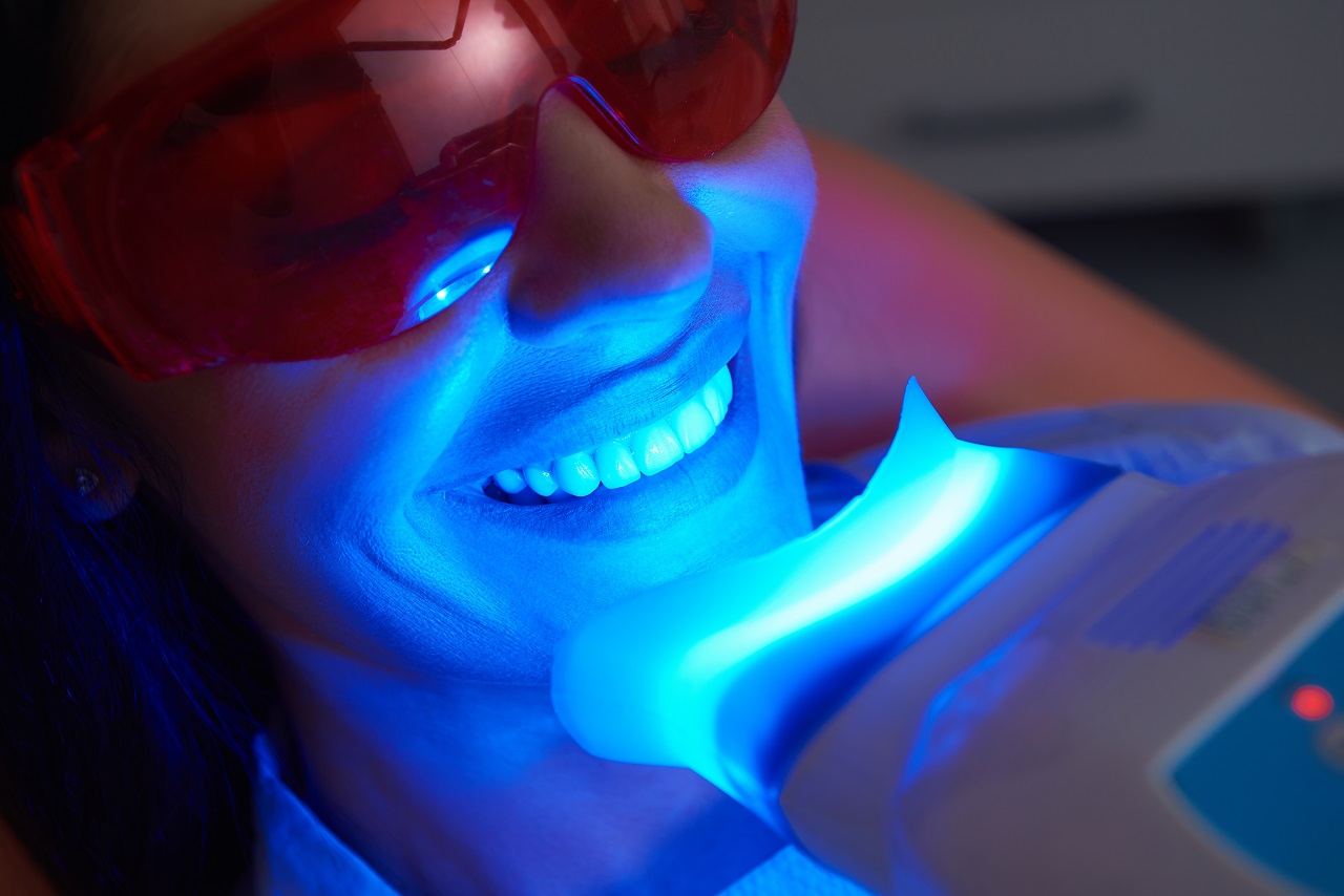 Wybielanie zębów – czy to bezpieczne?