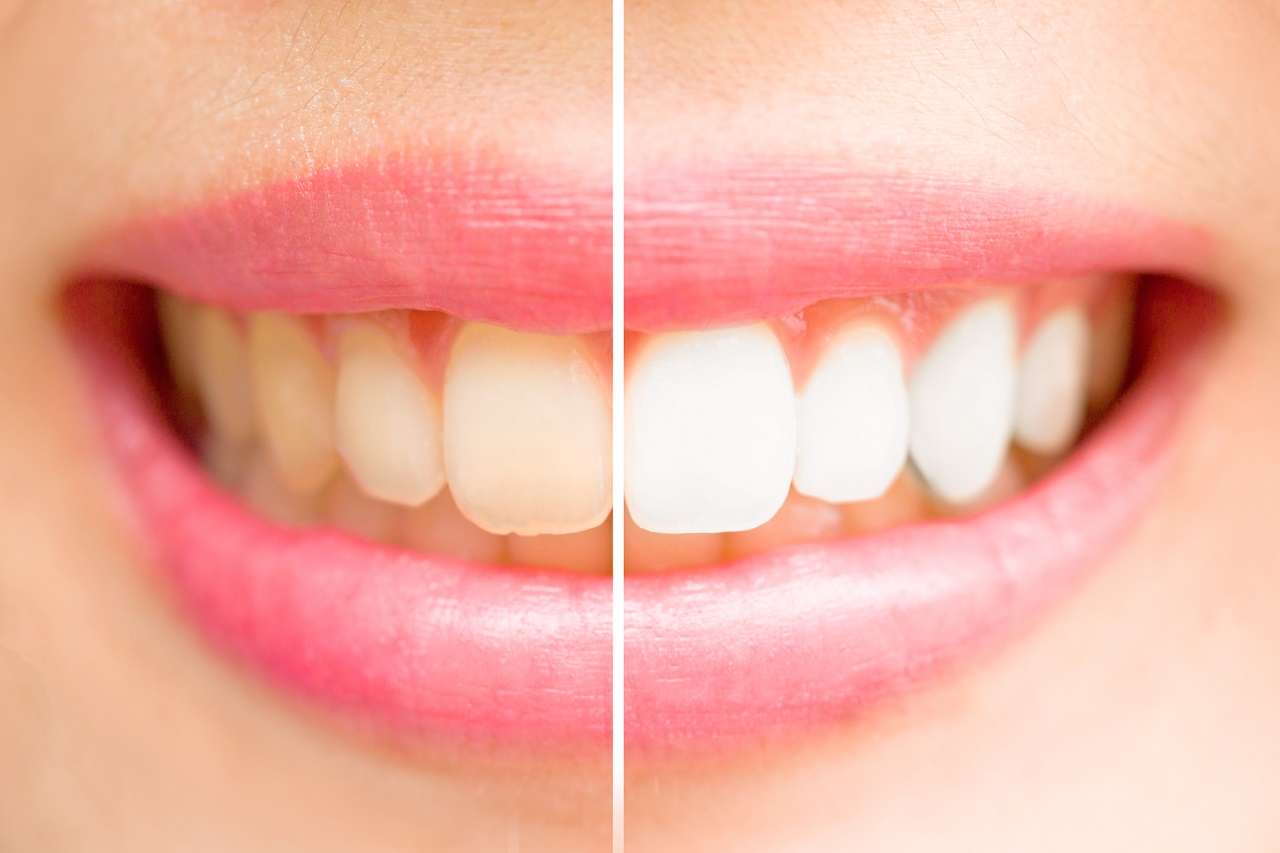 Kiedy warto zdecydować się na wybielanie zębów?